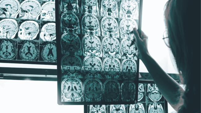 Un nou indicador d'asimetria cerebral permet quantificar l'evolució de la malaltia d'Alzheimer